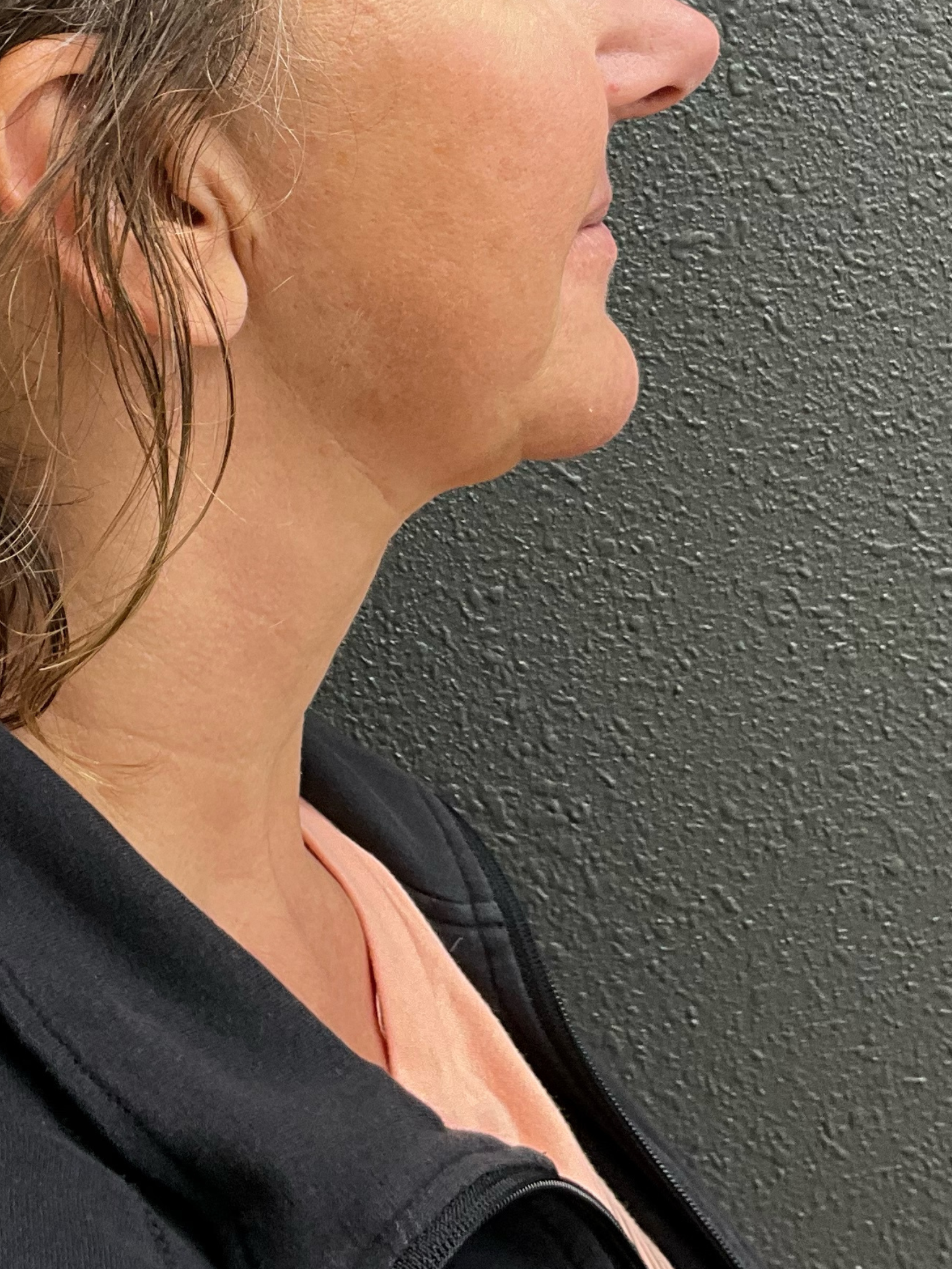 Facetite_After_4.png