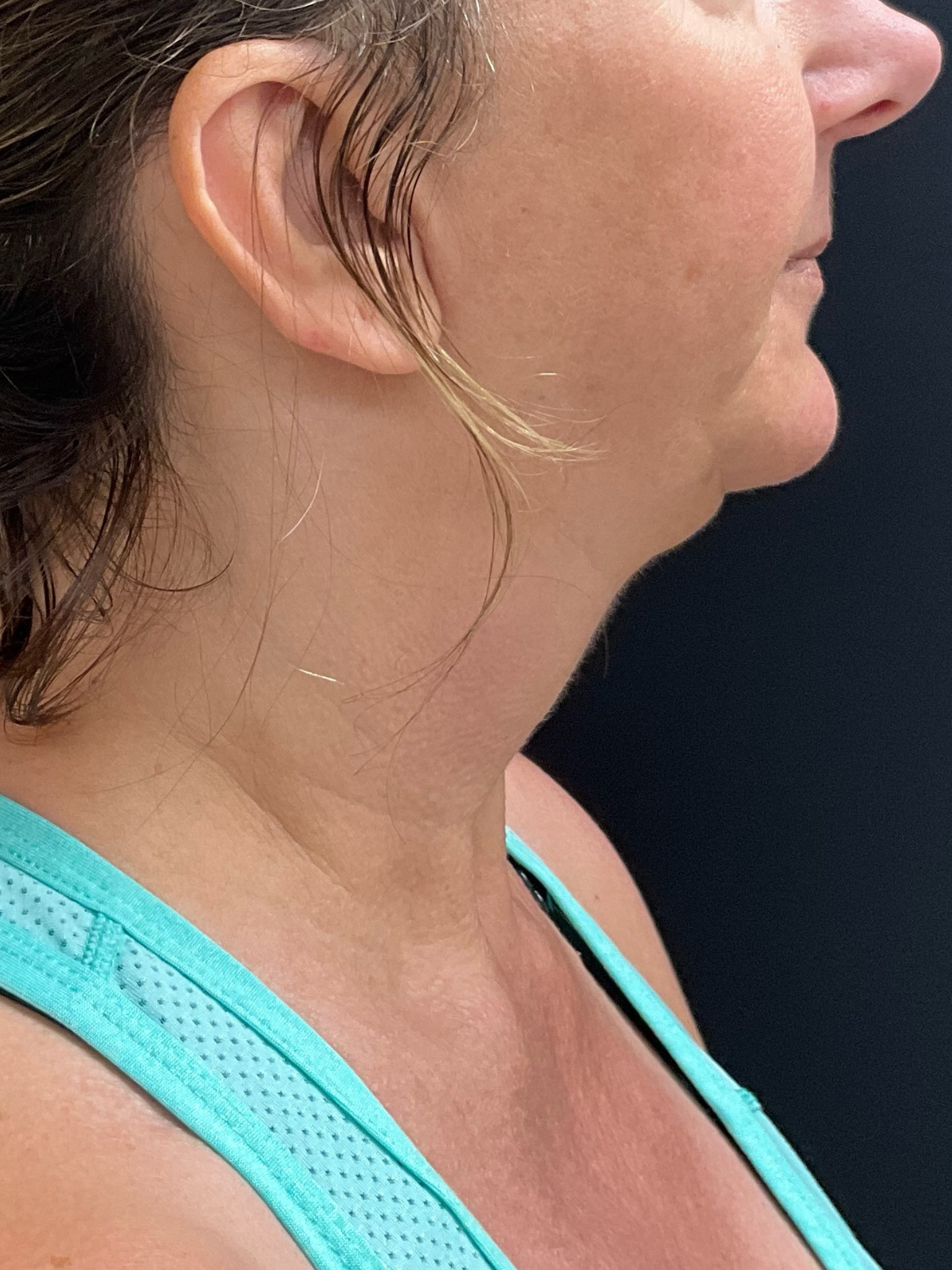 Facetite_Before_4.png